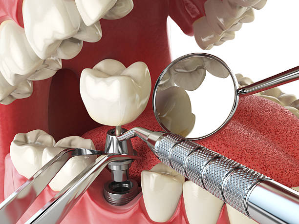 Best Emergency Root Canal Treatment in Longtown, OK